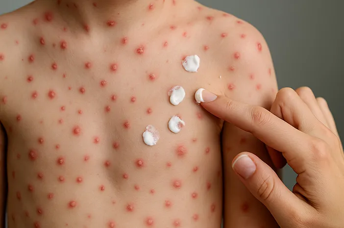 Cacar Api pada Anak: Gejala, Penyebab, Pengobatan, dan Pencegahan