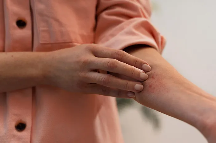 Cacar Api Menular? Mitos Atau Fakta? Yuk, Cek!