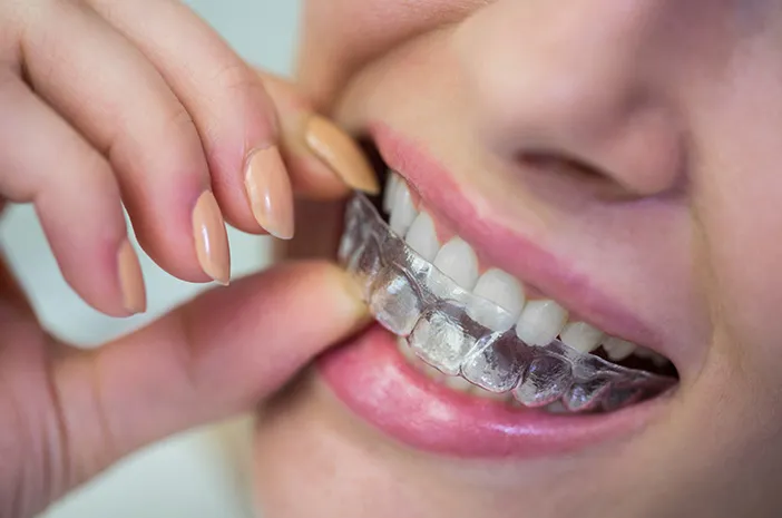 Behel Transparan: Solusi Gigi Rapi, dan Lebih Percaya Diri
