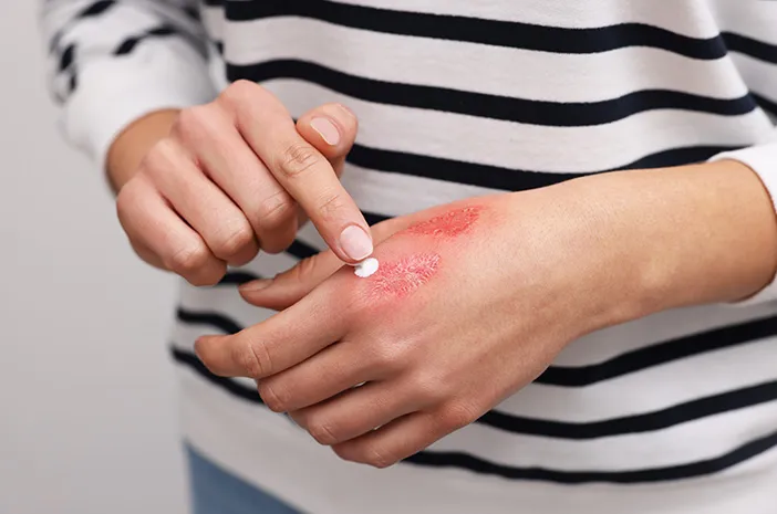 Salep untuk Luka Bernanah: Pilih yang Tepat!