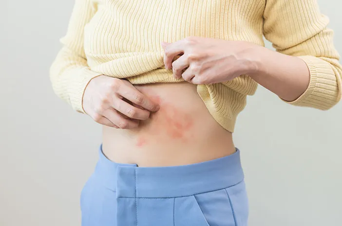 Herpes Zoster? Ini Perawatan Diri yang Tepat!
