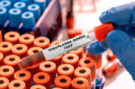 Toxoplasma Gondii: Kenali, Gejala, dan Pencegahan
