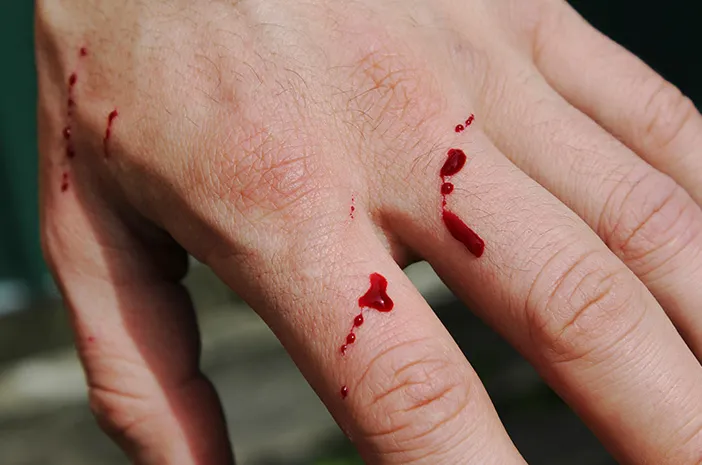 Tangan Berdarah: Penyebab, Cara Menangani dan Pertolongan