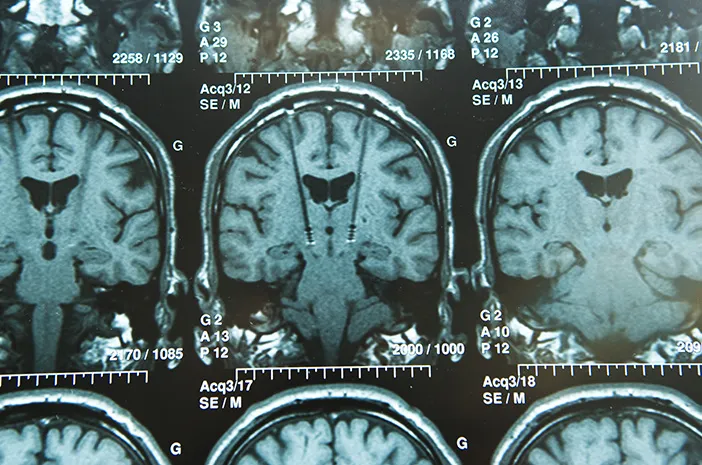 Deep Brain Stimulation, Pengobatan untuk Penyakit Parkinson