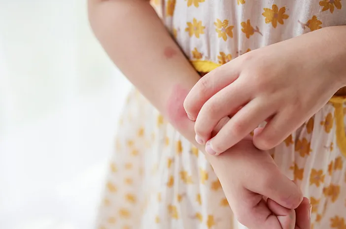 Cara Tepat Merawat Kulit Rentan Eksim pada Anak