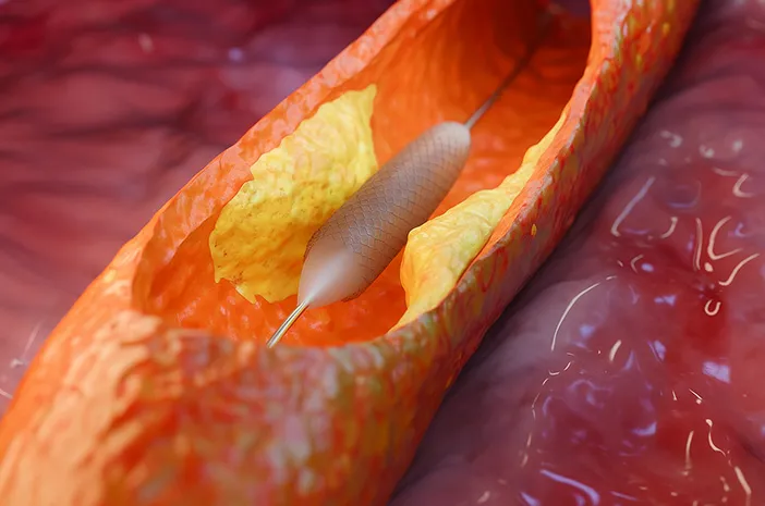 Jantung Sehat dengan PCI: Panduan Lengkap