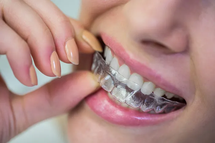 Mengenal Invisalign: Persiapan dan Perawatannya