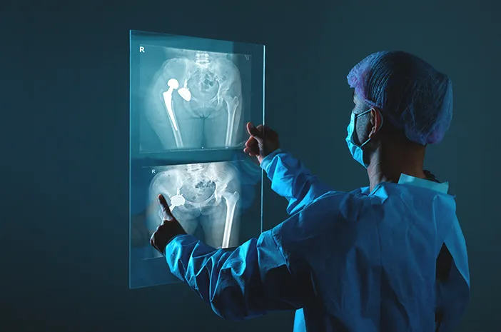 Hip Replacement: Prosedur, Manfaat, dan Pemulihannya