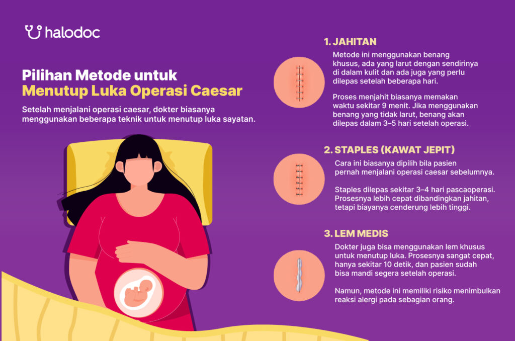 luka operasi caesar, tanda jahitan caesar bagian dalam sudah kering, luka operasi, operasi caesar