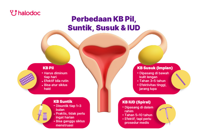 Perbedaan KB Pil, Suntik, Susuk dan IUD