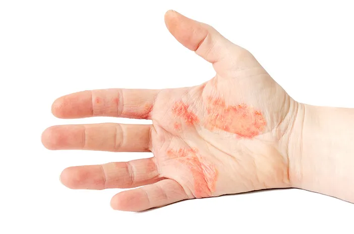 Ini Gejala Dishidrosis atau Pompholyx yang Perlu Diwaspadai