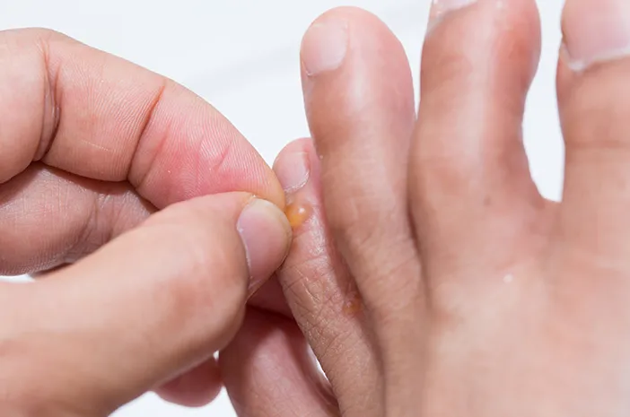 Dishidrosis, Ini Penyebab dan Faktor Risikonya