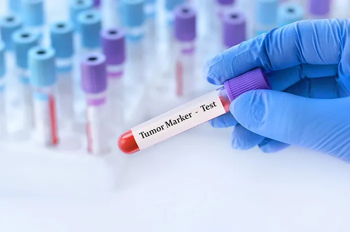 Apa Itu Tumor Marker dan Mengapa Penting untuk Deteksi Kanker?