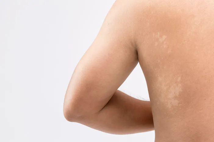 Cara Menghilangkan Panu dengan Efektif dan Aman