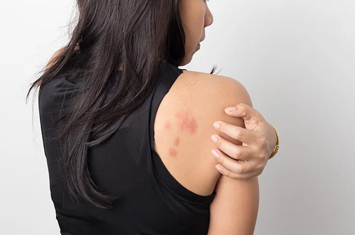 Panduan WHO tentang Herpes Zoster: Kenali Gejala dan Penanganannya