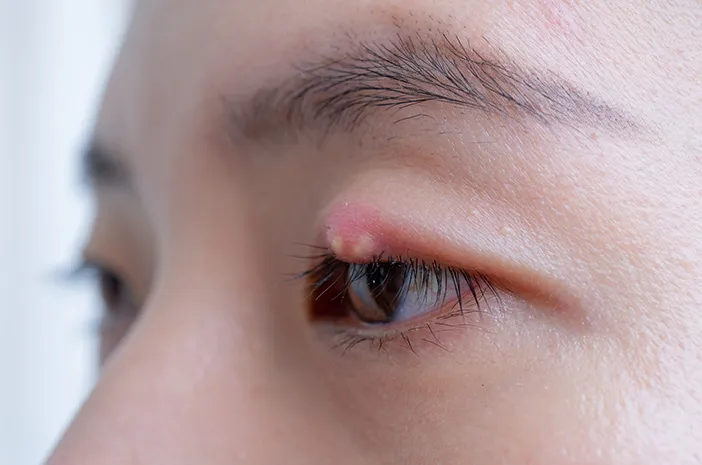 Insisi Kalazion: Prosedur dan Panduan Lengkapnya