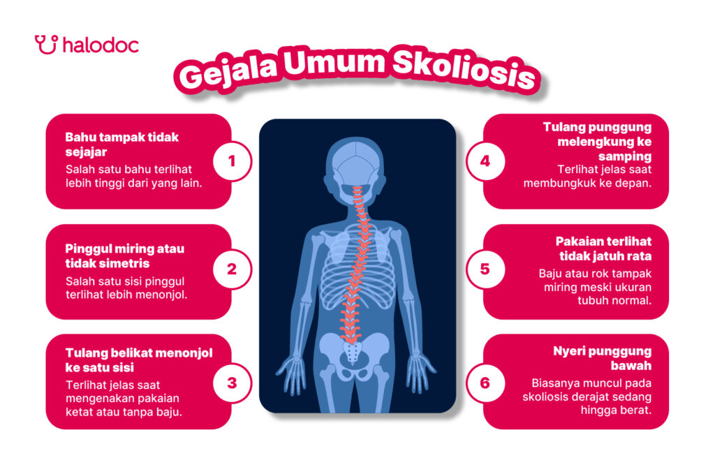 Gejala Umum Skoliosis