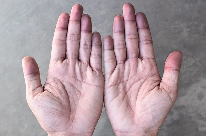 Sianosis: Ini Penyebab, Gejala, dan Cara Mengatasinya