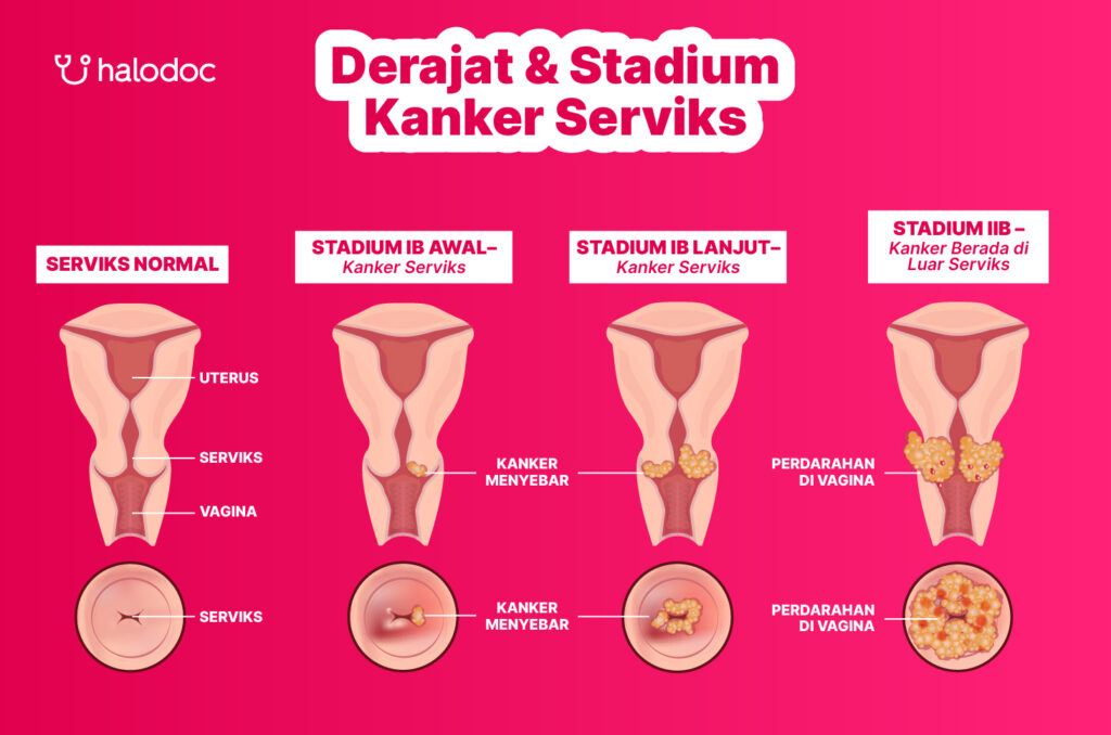 Ciri-Ciri Kanker Rahim