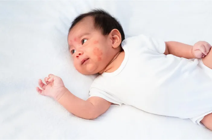 Mengenali Ciri Alergi Susu Sapi pada Anak dan Cara Menanganinya