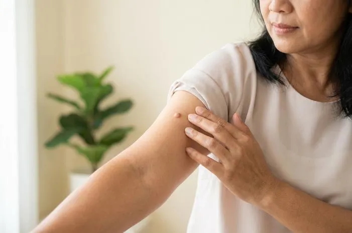 Fibroma: Kenali Gejala, Penyebab & Cara Mengatasinya