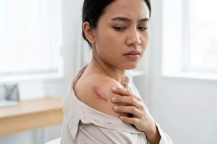 Keloid Gatal: Penyebab, Cara Mengatasi, dan Kapan ke Dokter