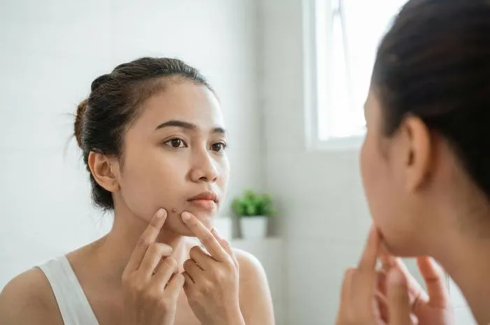Pimple? Atasi Jerawat dengan Cepat dan Efektif!