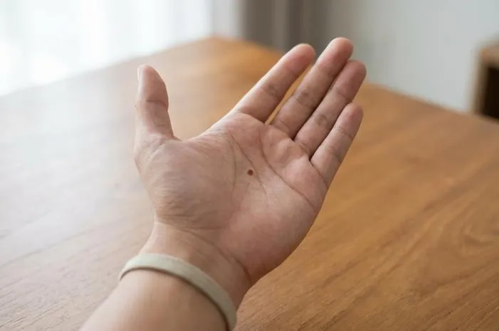 Arti Tahi Lalat di Telapak Tangan Kanan: Pertanda Apa?