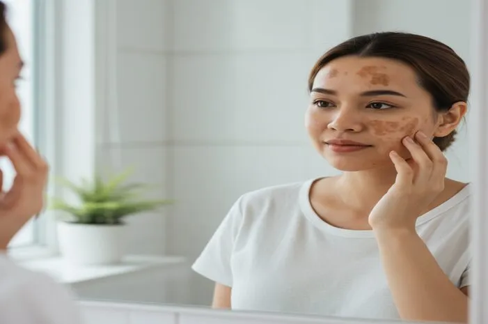 Cloasma Gravidarum: Kenali Penyebab dan Cara Mengatasi