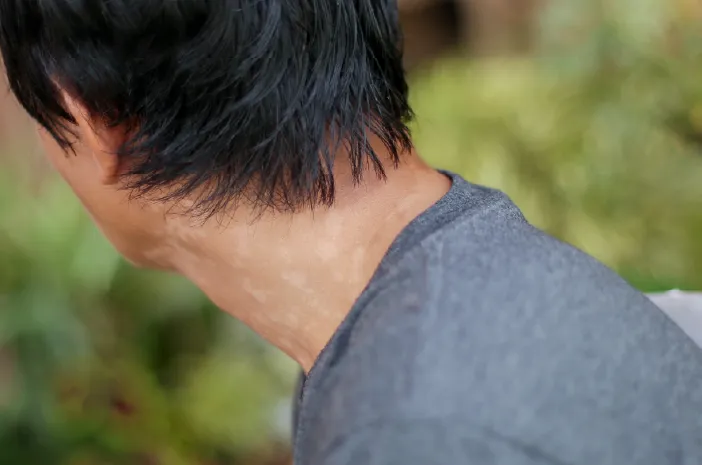 Apa Penyebab Banyak Panu di Badan? Ini yang Perlu Kamu Ketahui