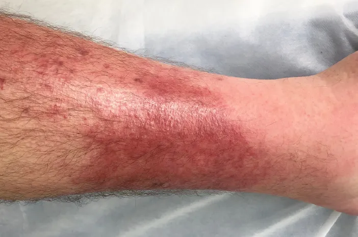 Alami Selulitis, Kapan Perlu Memeriksakan Diri ke Dokter?