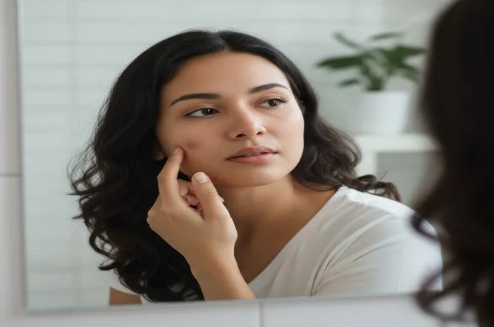 Dark Spot Itu Apa? Penyebab dan Cara Ampuh Hilangkannya