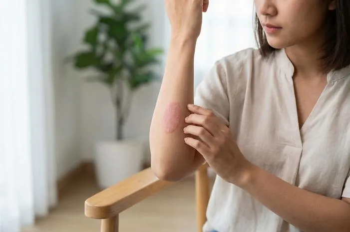 Kenali Herald Patch: Bercak Awal Pityriasis Rosea