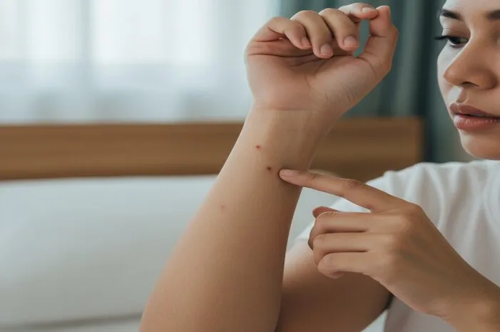 Bercak Merah DBD: Begini Cara Mengenalinya