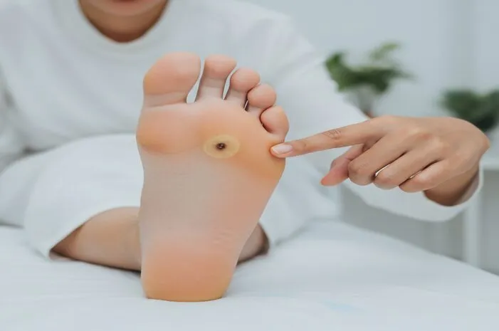 Pahami Mata Ikan Disebabkan Oleh Tekanan Atau Virus HPV