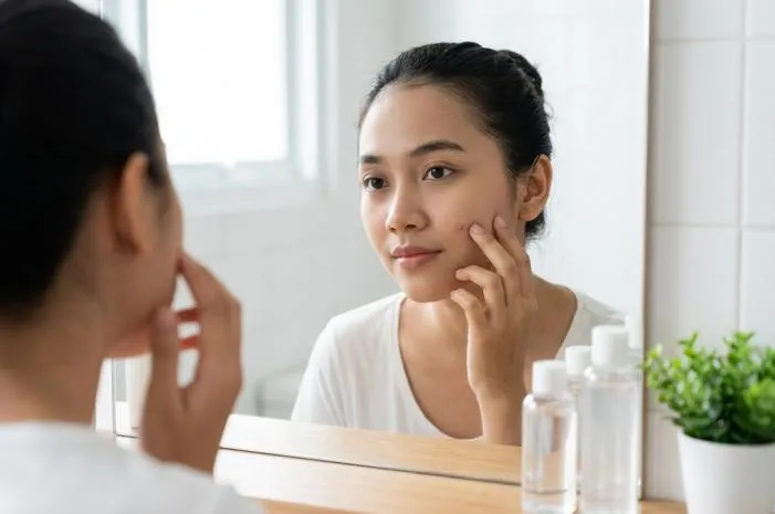Kenali Acne Prone Skin Penyebab dan Cara Merawatnya
