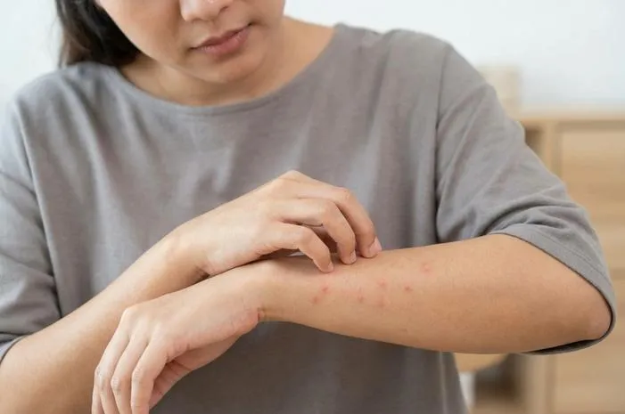 Badan Bentol Gatal: Penyebab, Atasi, Kapan ke Dokter