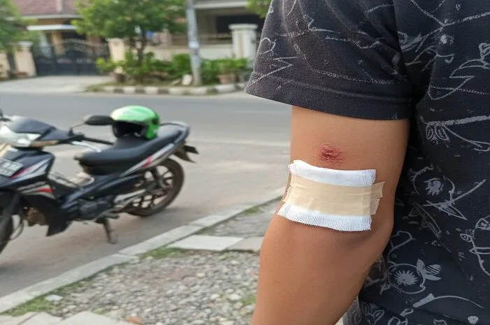Luka Siku Jatuh Motor? Ini Cara Penanganan Cepatnya