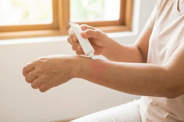 Salep Bufacort untuk Gatal: Ampuh, Asal Tahu Caranya!