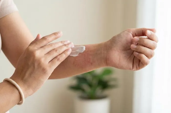 Penyakit Eksim: Kenali Gejala, Penyebab dan Solusinya