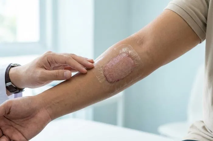 Cangkok Kulit: Solusi Perbaiki Kulit Rusak Kembali Mulus