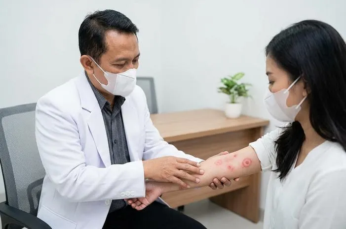 Erythema Multiforme: Ruam Target yang Tak Perlu Ditakuti