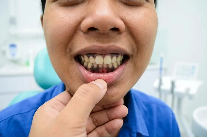 Gusi Hitam Mengganggu? Kenali dan Atasi Sekarang!