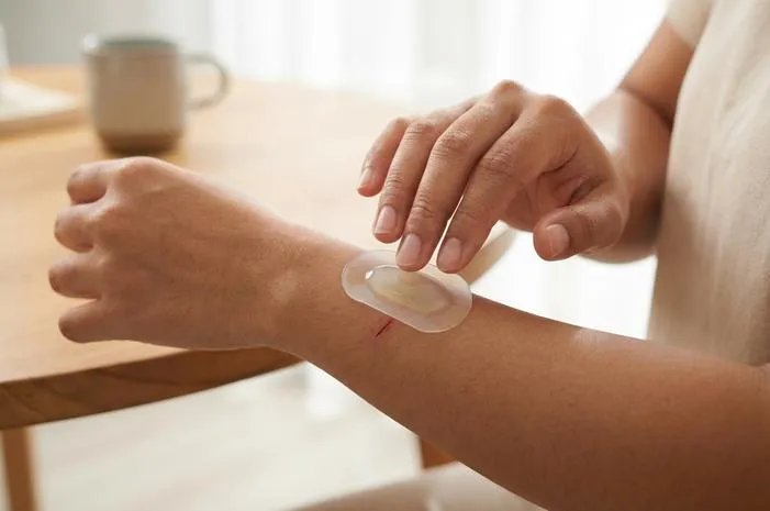 Hydrocolloid: Bikin Jerawat Kempes Luka Cepat Pulih