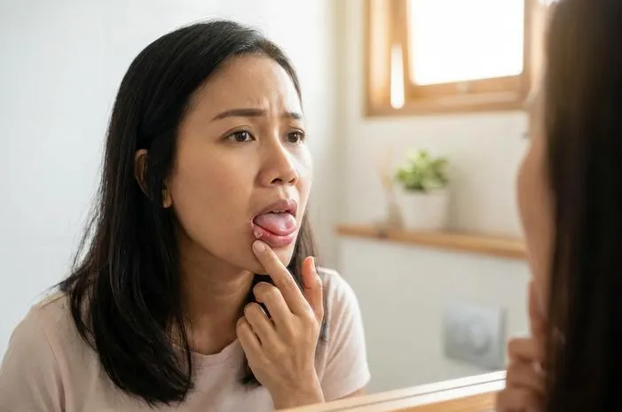 Lidah Melepuh? Ini Cara Redakan Perih di Rumah