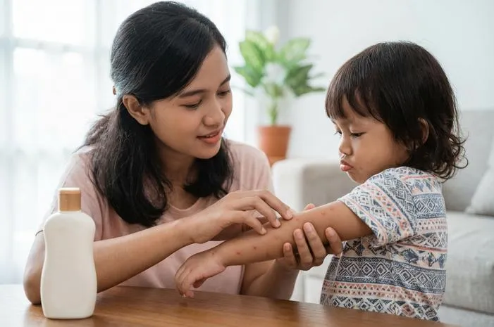 Contoh Cacar Air: Kenali Ciri dan Tahap Bintik Merahnya