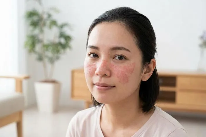 Kulit Merah Mirip Kupu-kupu? Ternyata Butterfly Rash!
