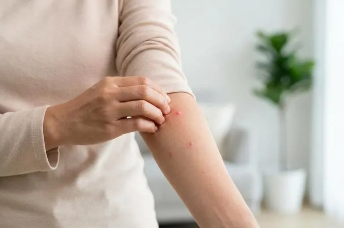 Gatal Bentol Merah? Pahami Penyebab Atasi Mudah