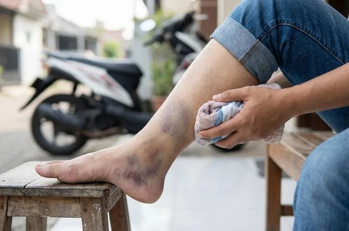 Kaki Memar Jatuh dari Motor? Ini Cara Mudah Mengatasinya