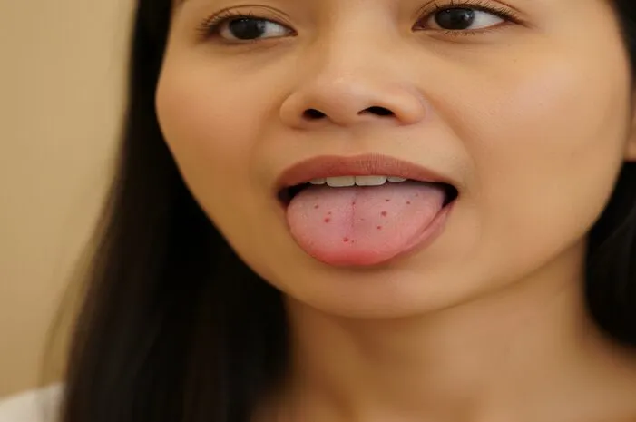 Kenali Gambar Lidah Bintik Merah: Penyebab, Gejala, Solusi